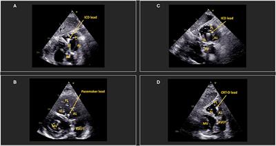 Case Report: Assessing the Position of Pacemaker Leads via Transthoracic Echocardiography: Additional Value of the Subcostal En Face View